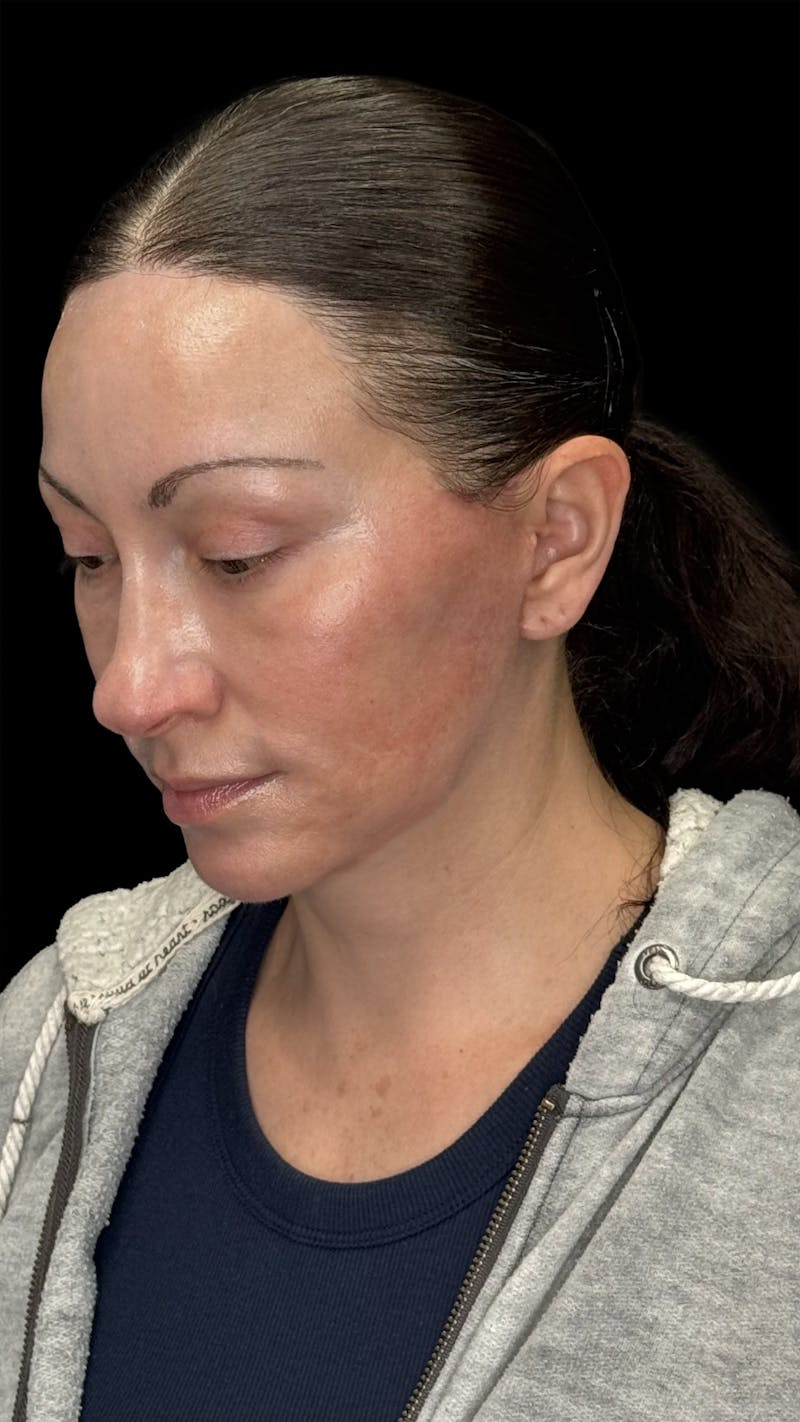 Deep Plane Facelift 40s Before & After Gallery - Patient 100332 - Image 4