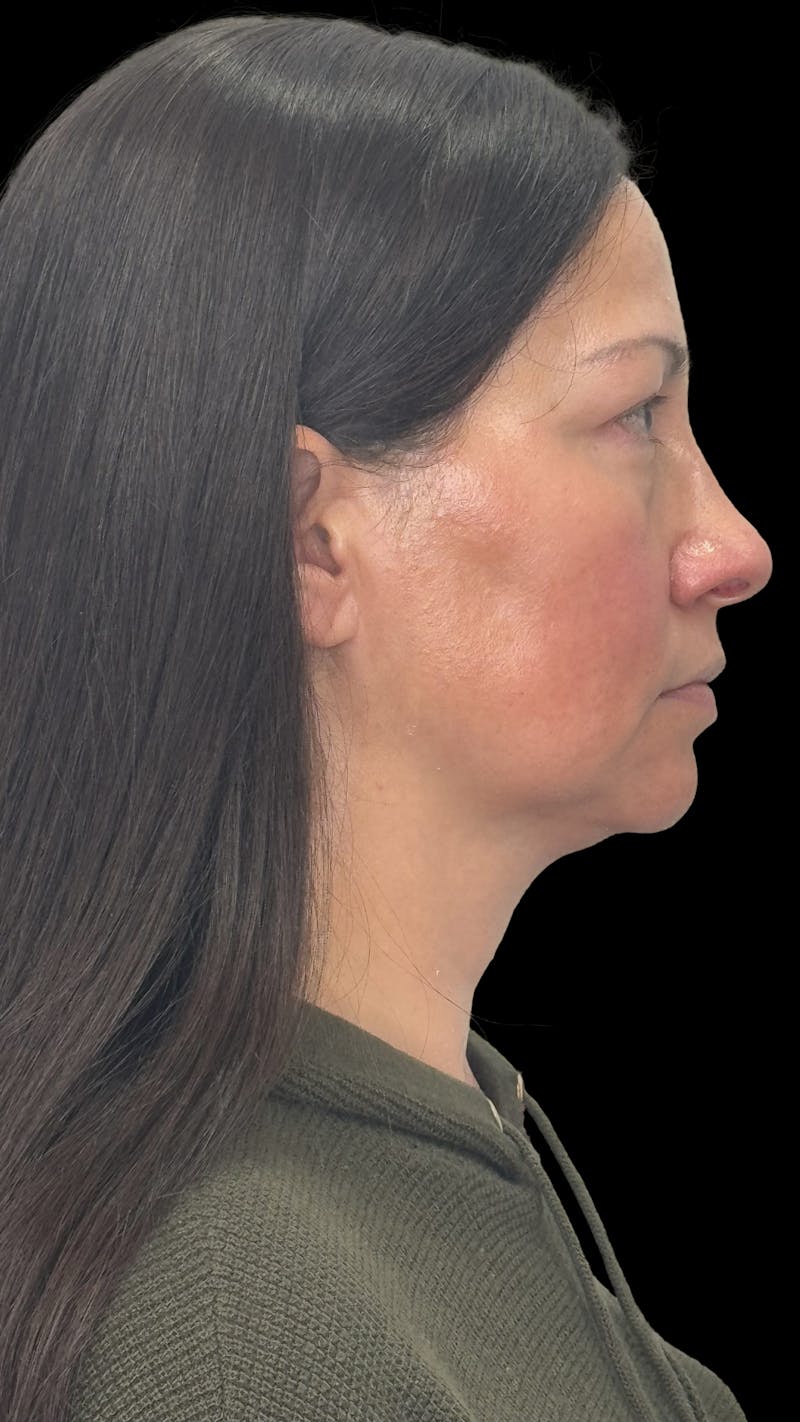 Deep Plane Facelift 40s Before & After Gallery - Patient 100332 - Image 9