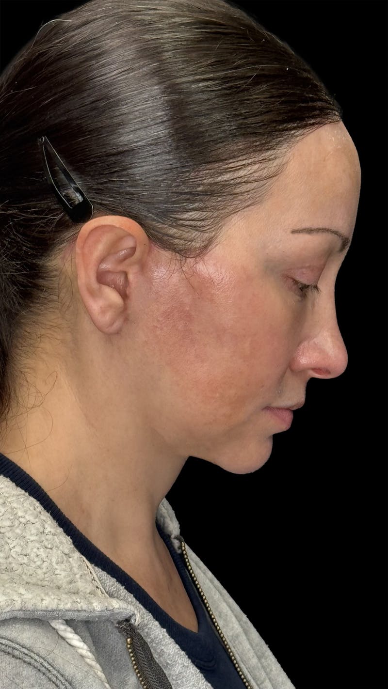 Deep Plane Facelift 40s Before & After Gallery - Patient 100332 - Image 6