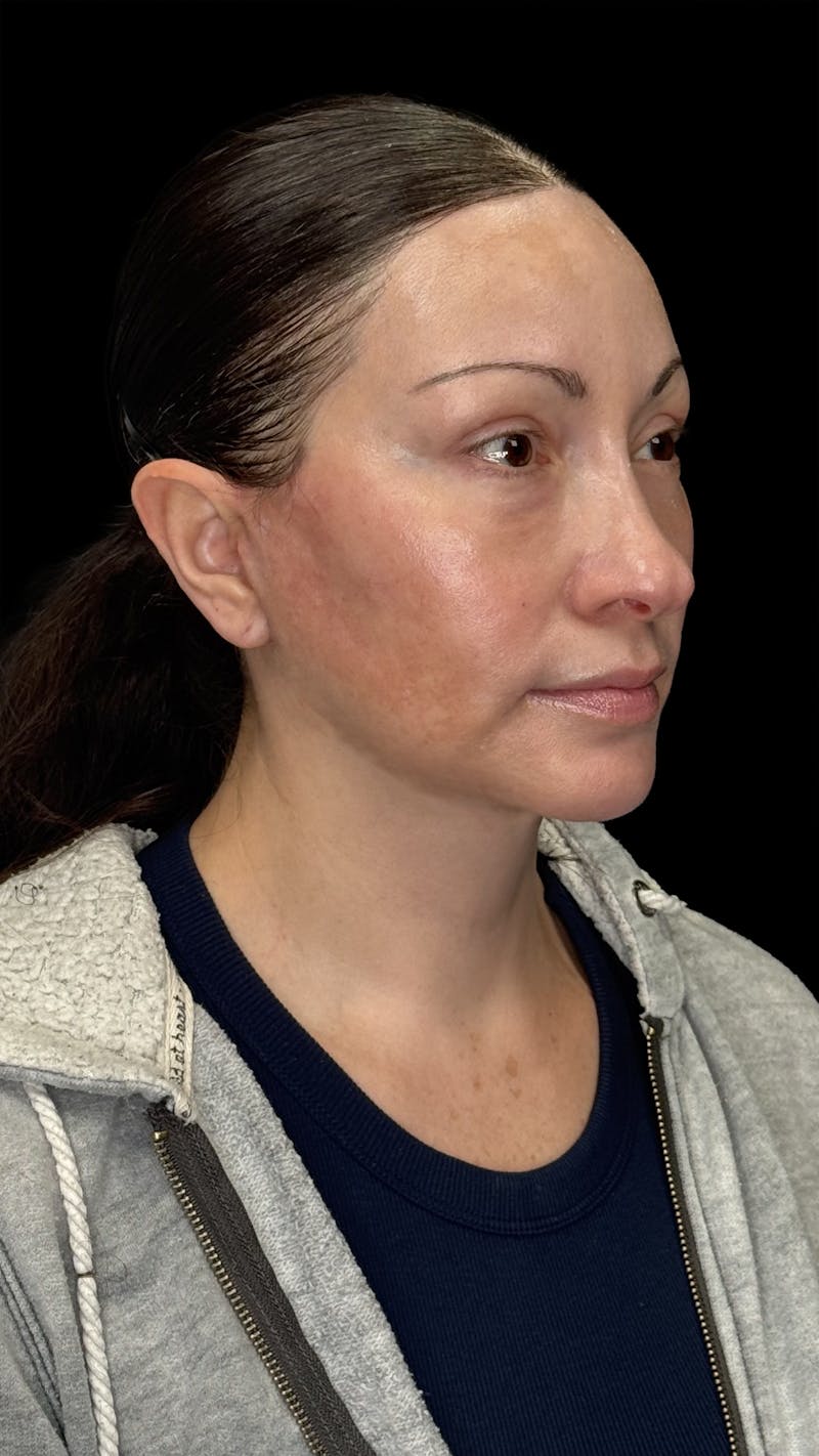 Deep Plane Facelift 40s Before & After Gallery - Patient 100332 - Image 8
