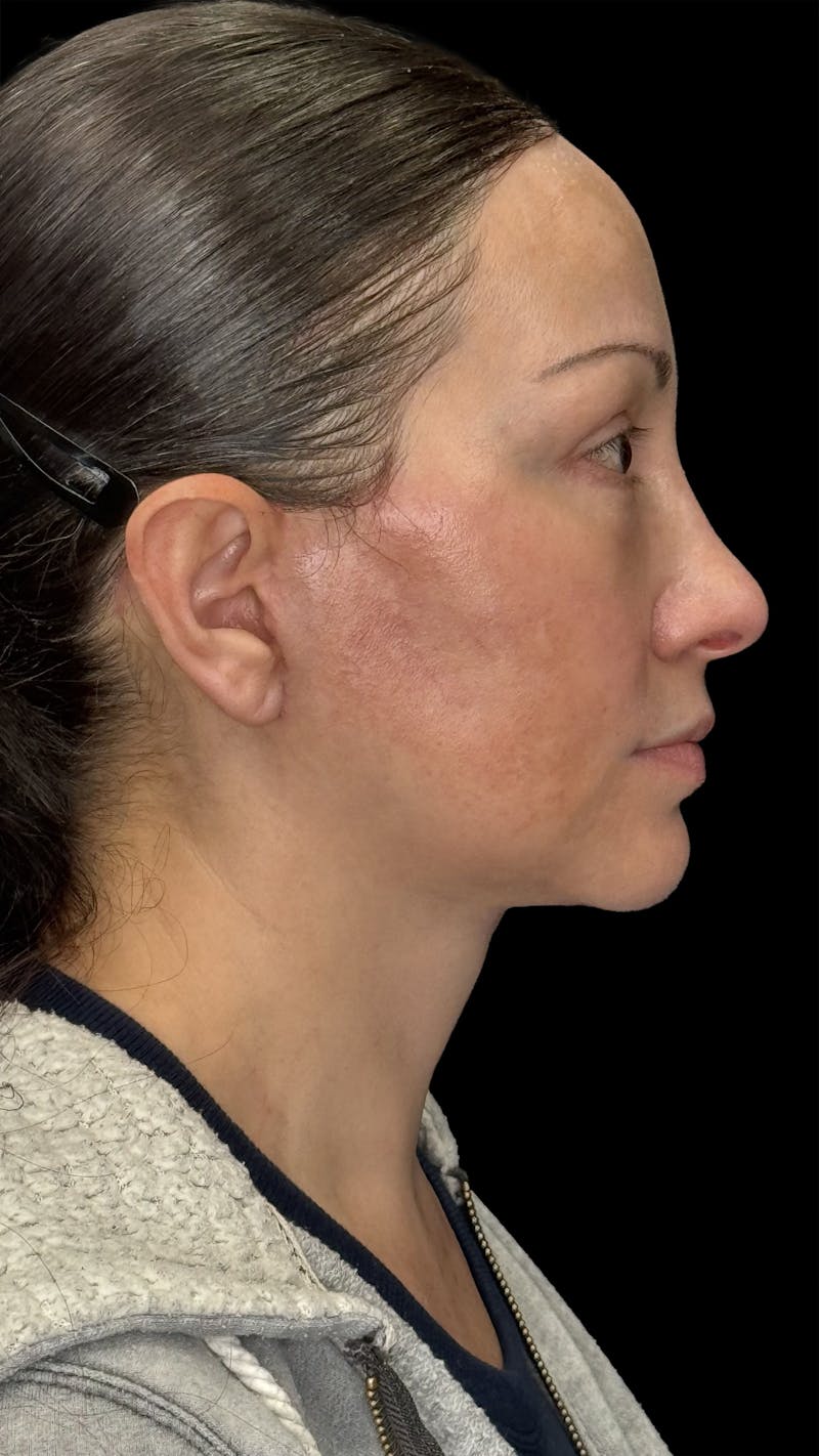 Deep Plane Facelift 40s Before & After Gallery - Patient 100332 - Image 10