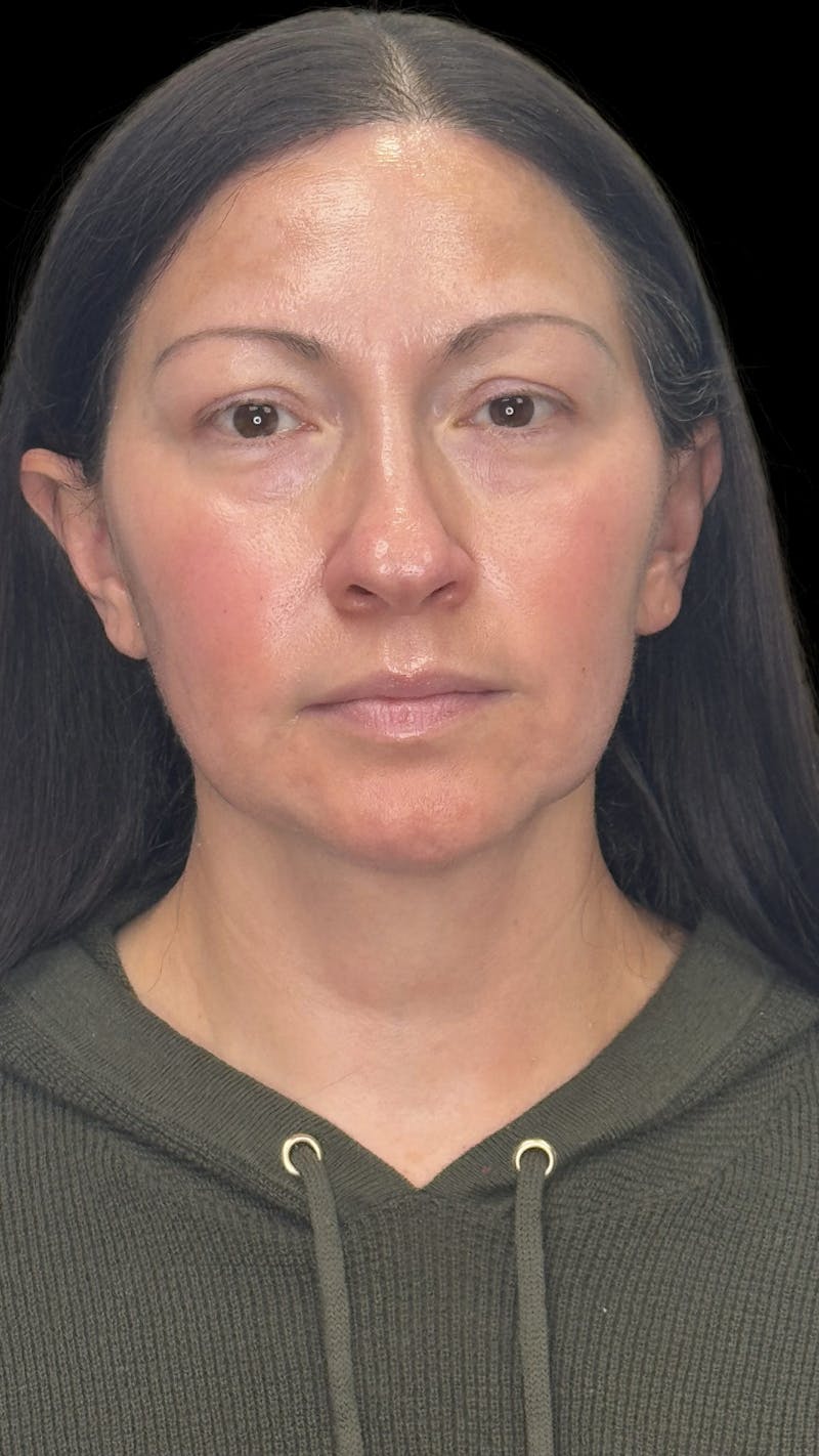 Deep Plane Facelift 40s Before & After Gallery - Patient 100332 - Image 1