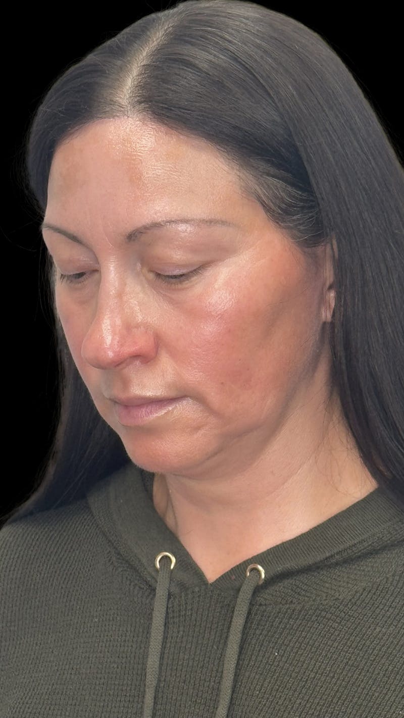Deep Plane Facelift 40s Before & After Gallery - Patient 100332 - Image 3