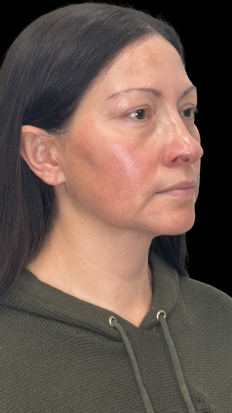 Deep Plane Facelift 40s Before & After Gallery - Patient 100332 - Image 7
