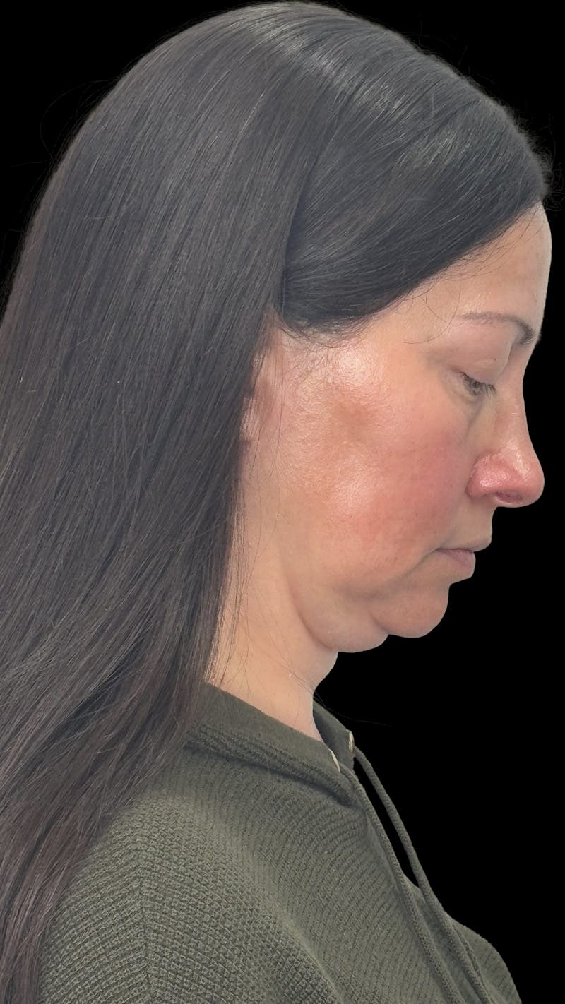 Deep Plane Facelift 40s Before & After Gallery - Patient 100332 - Image 5