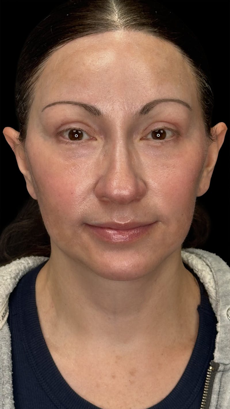 Deep Plane Facelift 40s Before & After Gallery - Patient 100332 - Image 2