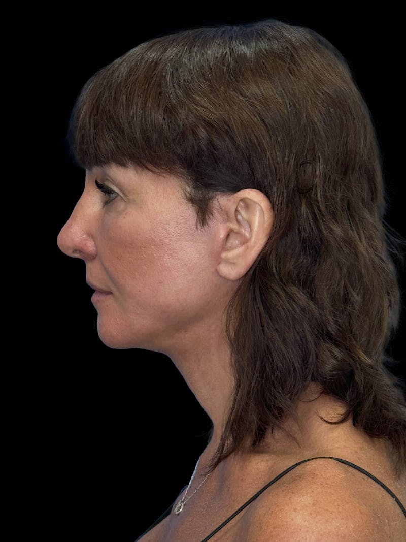 Deep Plane Facelift 40s Before & After Gallery - Patient 751195 - Image 6