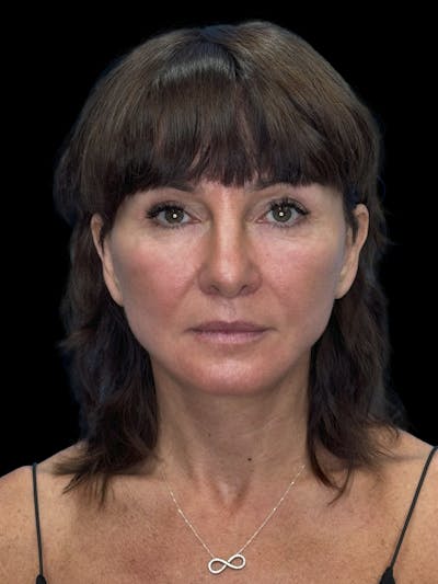 Deep Plane Facelift 40s Before & After Gallery - Patient 751195 - Image 2