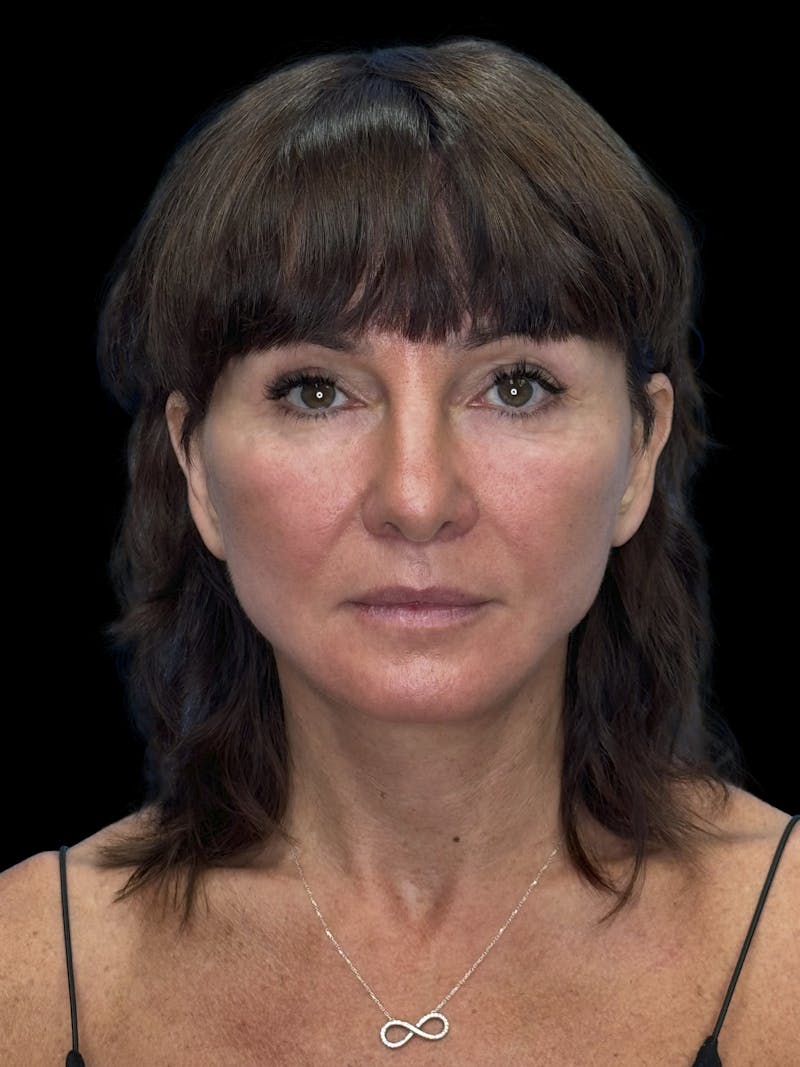 Deep Plane Facelift 40s Before & After Gallery - Patient 751195 - Image 2