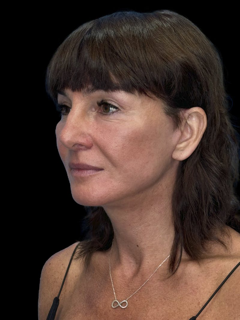 Deep Plane Facelift 40s Before & After Gallery - Patient 751195 - Image 4