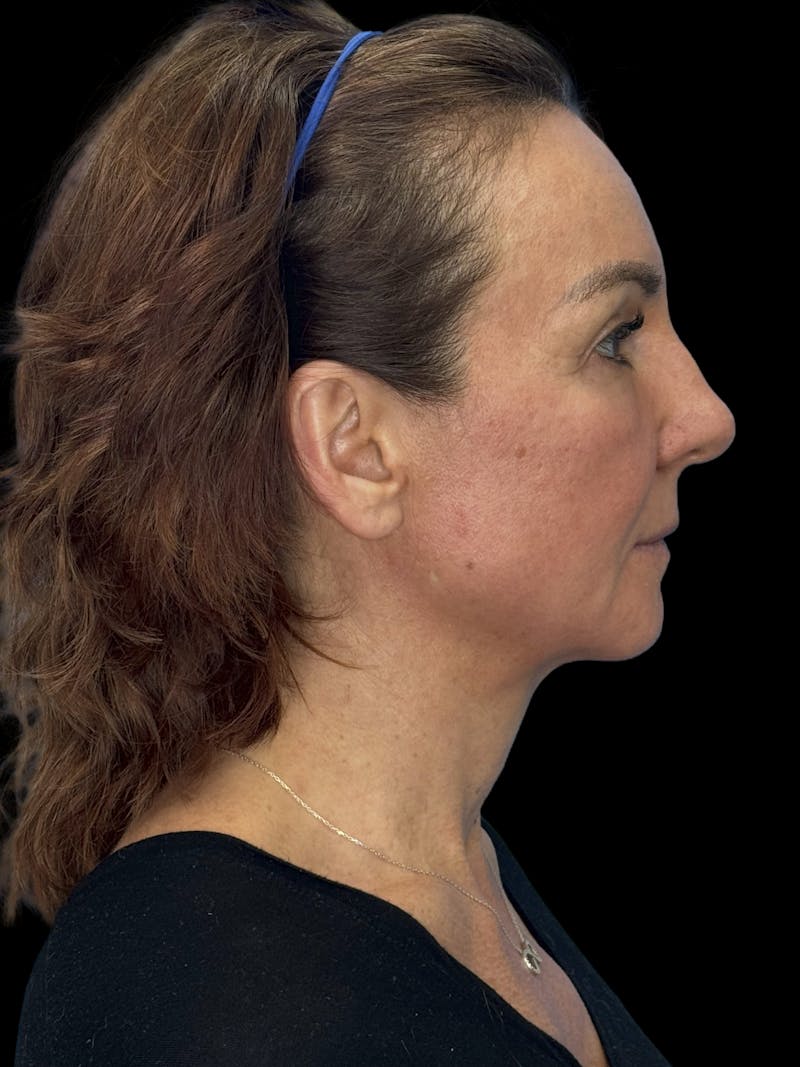 Deep Plane Facelift 40s Before & After Gallery - Patient 751195 - Image 9