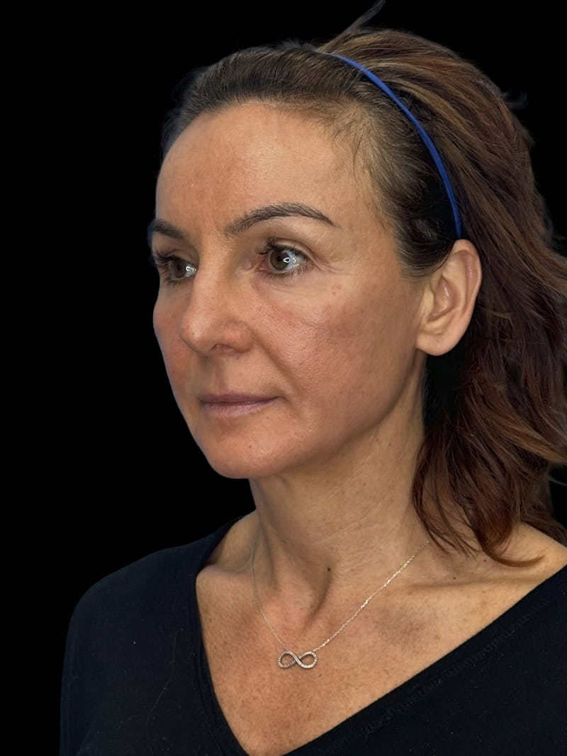 Deep Plane Facelift 40s Before & After Gallery - Patient 751195 - Image 3