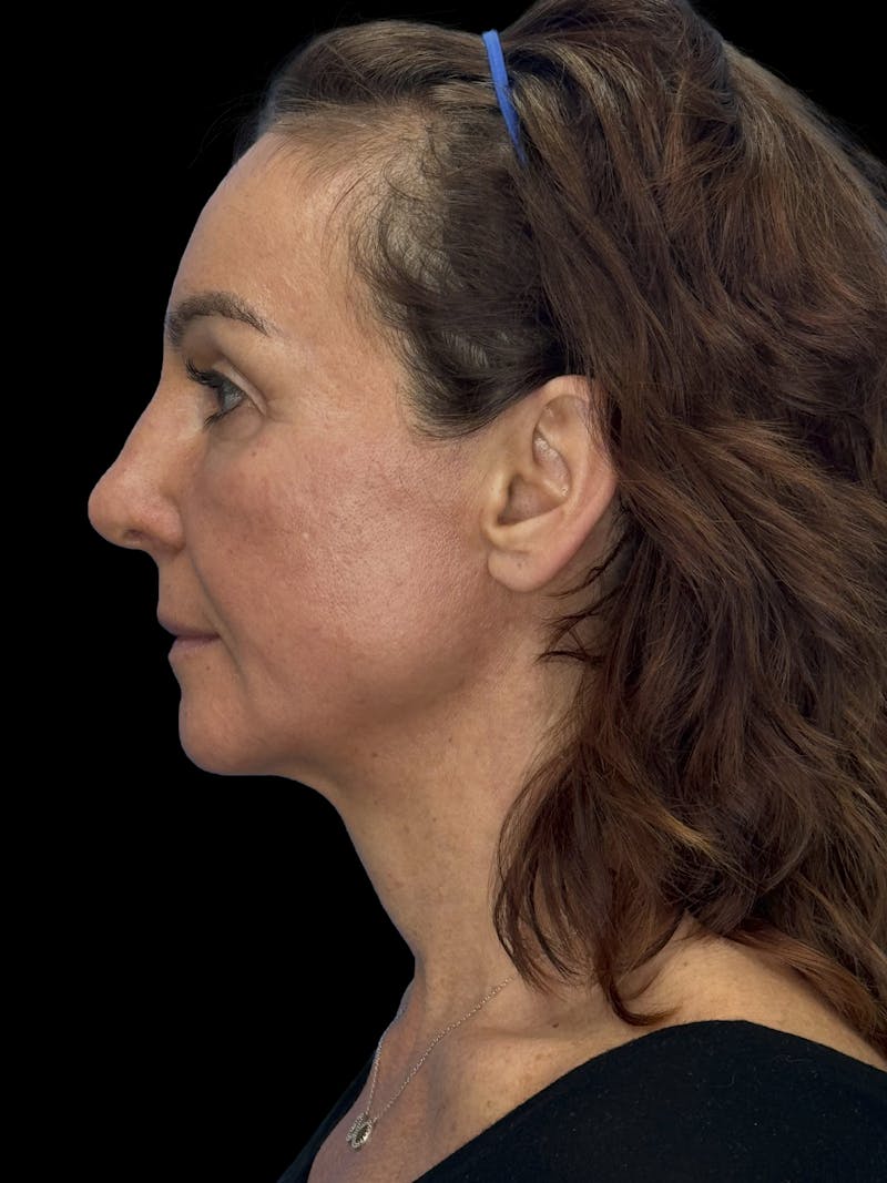 Deep Plane Facelift 40s Before & After Gallery - Patient 751195 - Image 5