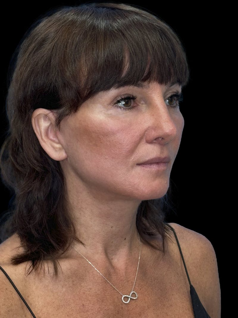 Deep Plane Facelift 40s Before & After Gallery - Patient 751195 - Image 8
