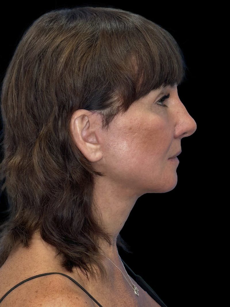 Deep Plane Facelift 40s Before & After Gallery - Patient 751195 - Image 10