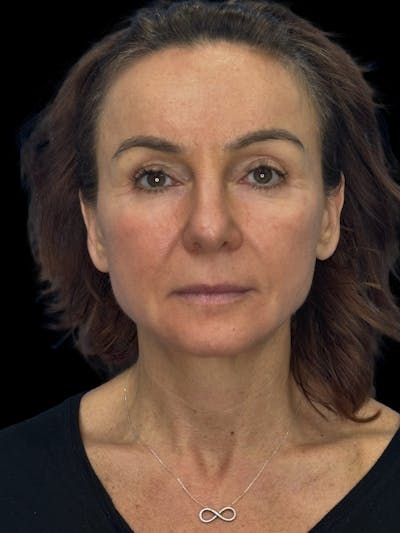 Deep Plane Facelift 40s Before & After Gallery - Patient 751195 - Image 1
