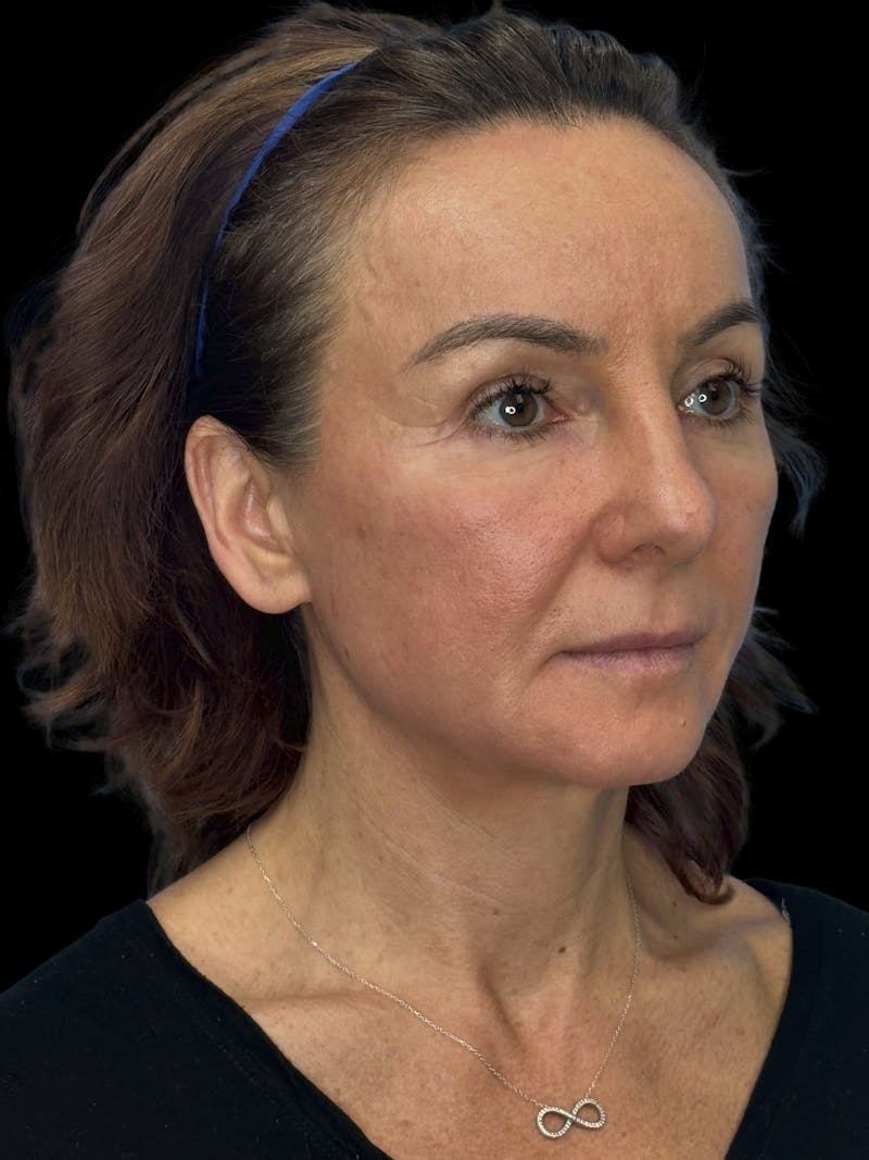 Deep Plane Facelift 40s Before & After Gallery - Patient 751195 - Image 7