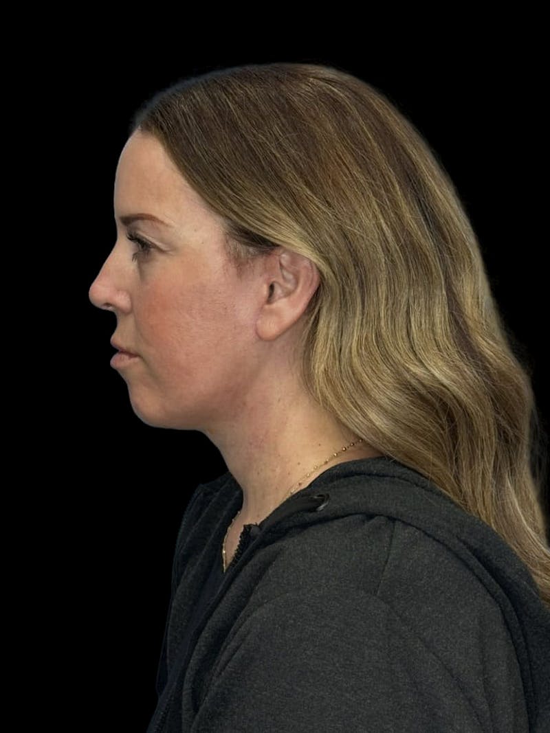 Deep Plane Facelift 40s Before & After Gallery - Patient 312257 - Image 6