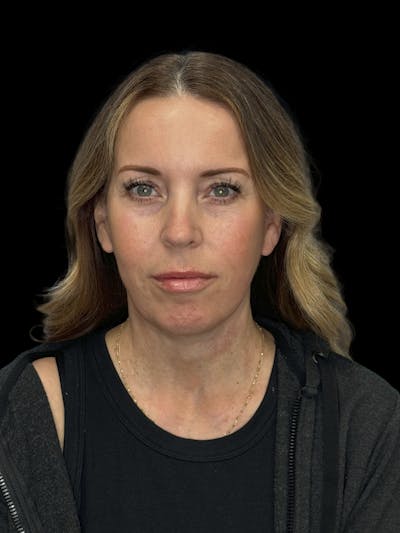 Deep Plane Facelift 40s Before & After Gallery - Patient 312257 - Image 2
