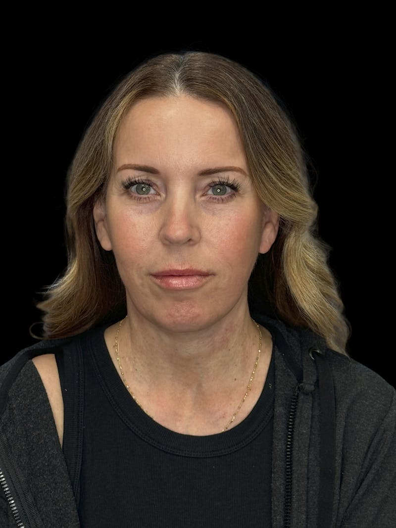 Deep Plane Facelift 40s Before & After Gallery - Patient 312257 - Image 2