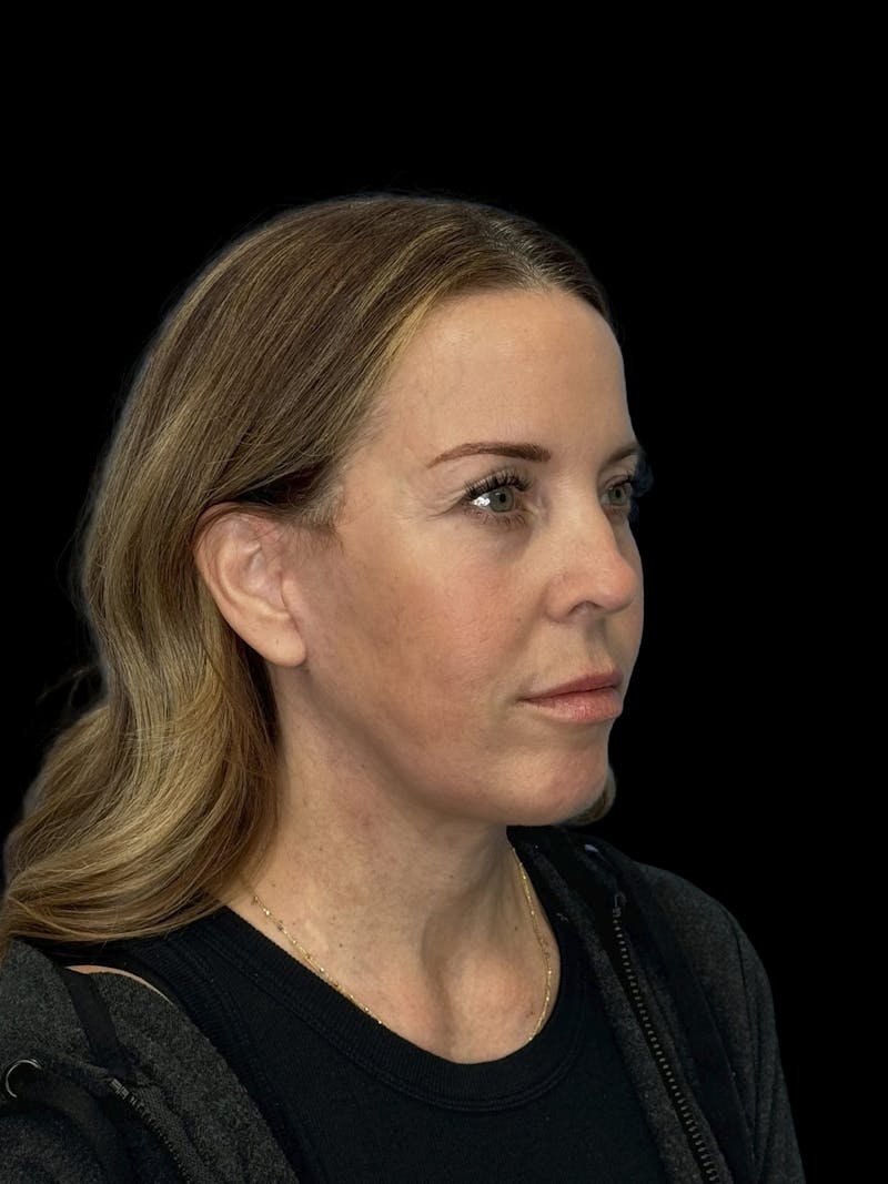 Deep Plane Facelift 40s Before & After Gallery - Patient 312257 - Image 8