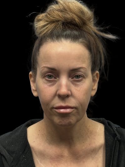 Deep Plane Facelift 40s Before & After Gallery - Patient 312257 - Image 1