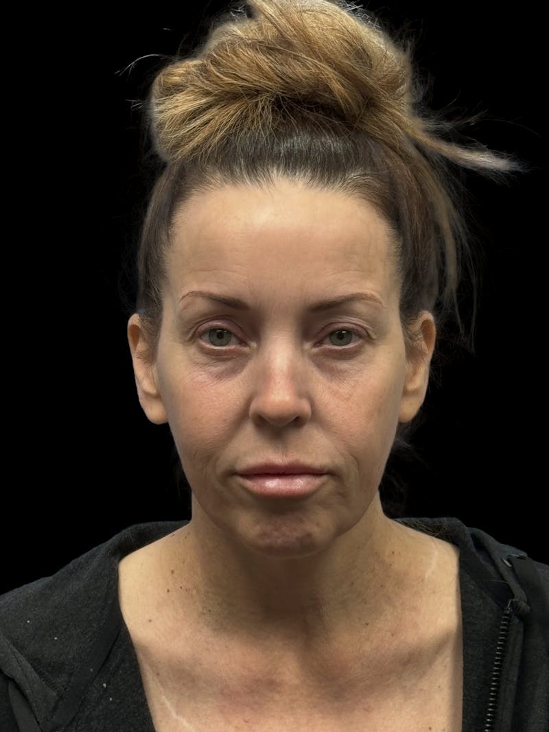 Deep Plane Facelift 40s Before & After Gallery - Patient 312257 - Image 1