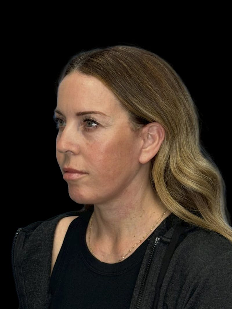 Deep Plane Facelift 40s Before & After Gallery - Patient 312257 - Image 4