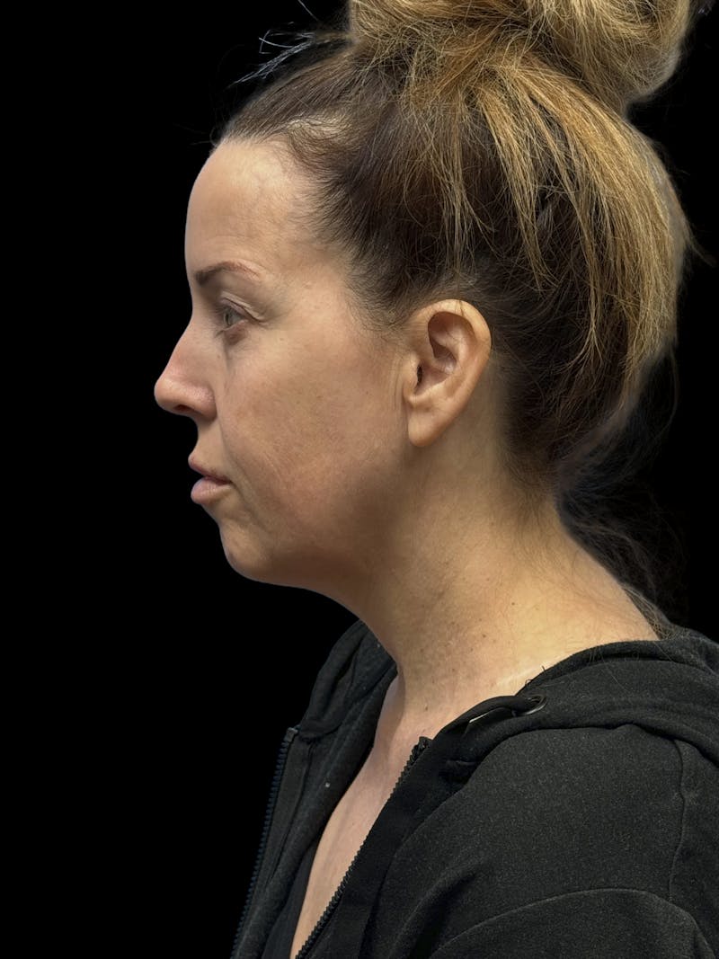 Deep Plane Facelift 40s Before & After Gallery - Patient 312257 - Image 5