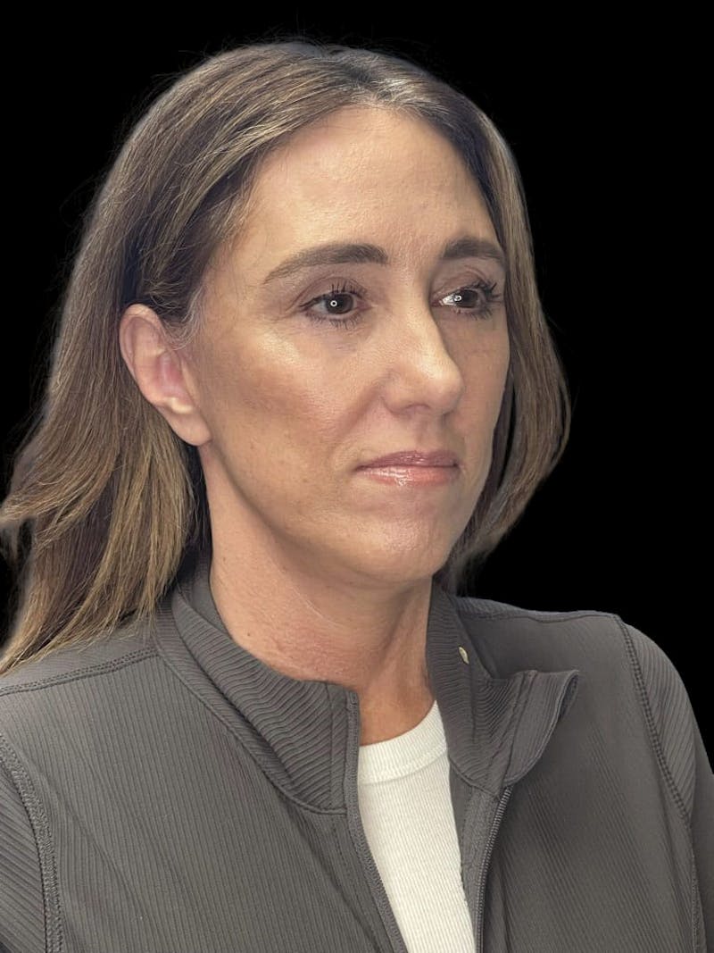 Deep Plane Facelift 40s Before & After Gallery - Patient 229141 - Image 6