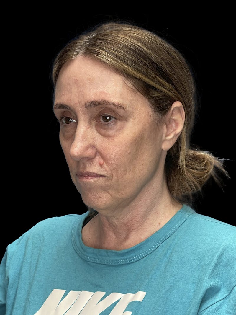 Deep Plane Facelift 40s Before & After Gallery - Patient 229141 - Image 3