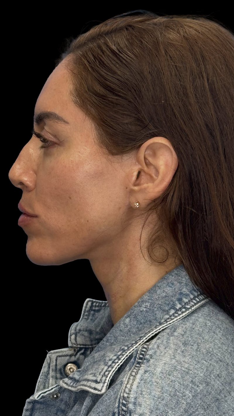 Deep Plane Facelift 40s Before & After Gallery - Patient 341532 - Image 6