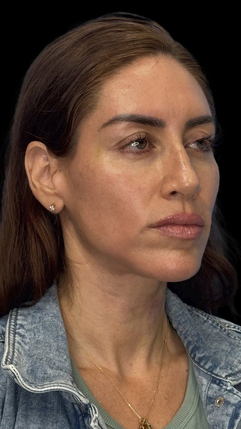 Deep Plane Facelift 40s Before & After Gallery - Patient 341532 - Image 8