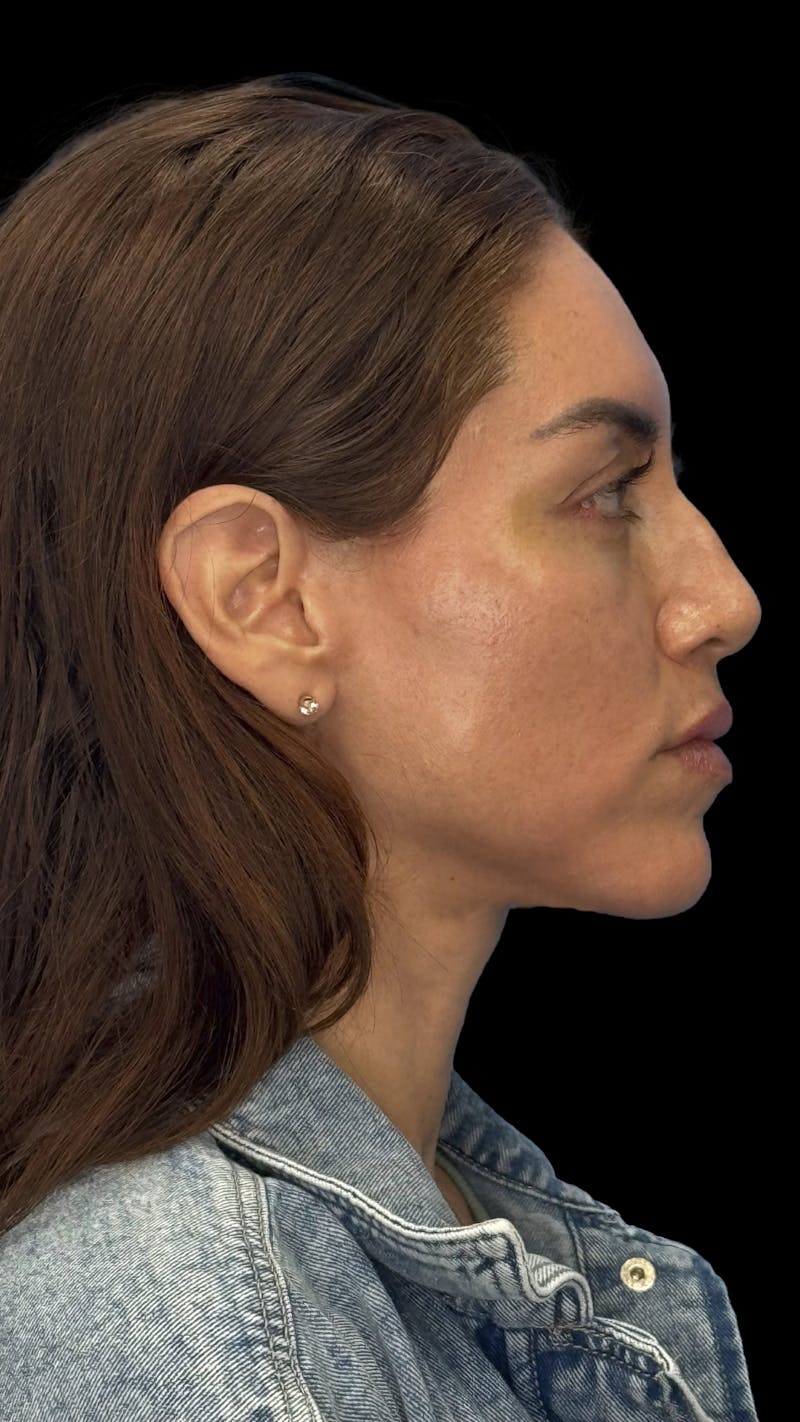 Deep Plane Facelift 40s Before & After Gallery - Patient 341532 - Image 10