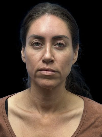 Deep Plane Facelift 40s Before & After Gallery - Patient 341532 - Image 1