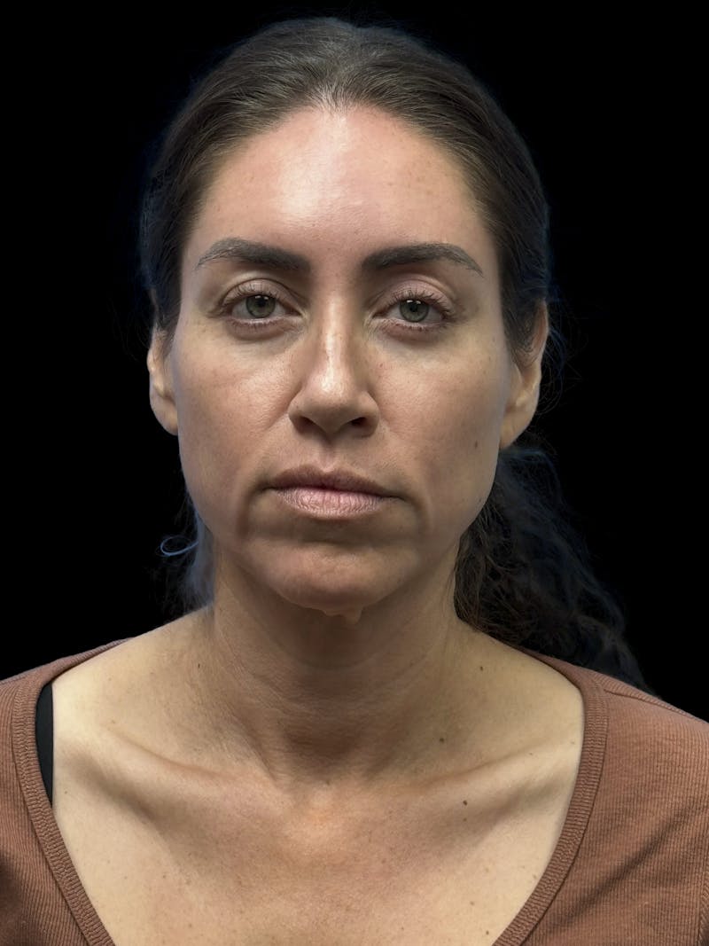Deep Plane Facelift 40s Before & After Gallery - Patient 341532 - Image 1