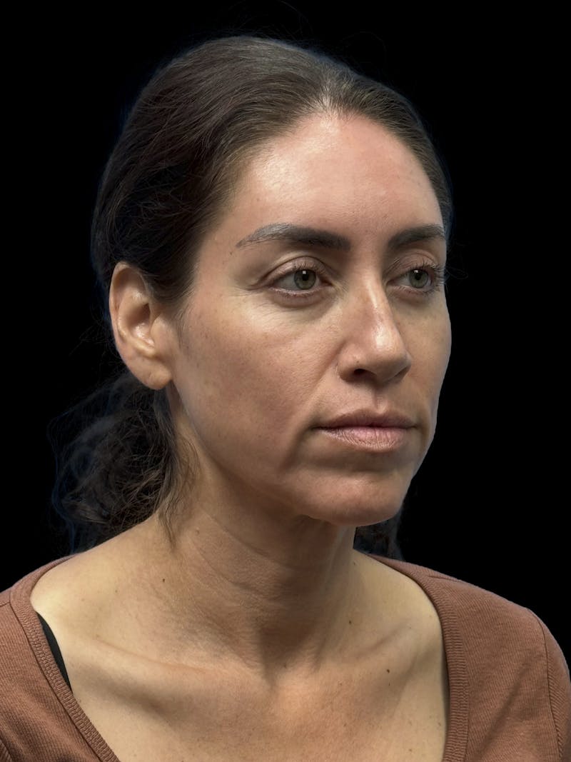 Deep Plane Facelift 40s Before & After Gallery - Patient 341532 - Image 7