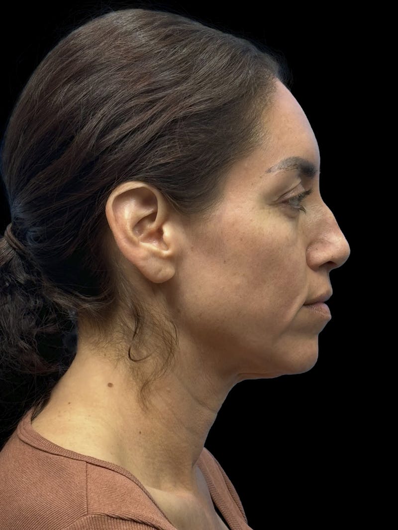 Deep Plane Facelift 40s Before & After Gallery - Patient 341532 - Image 9