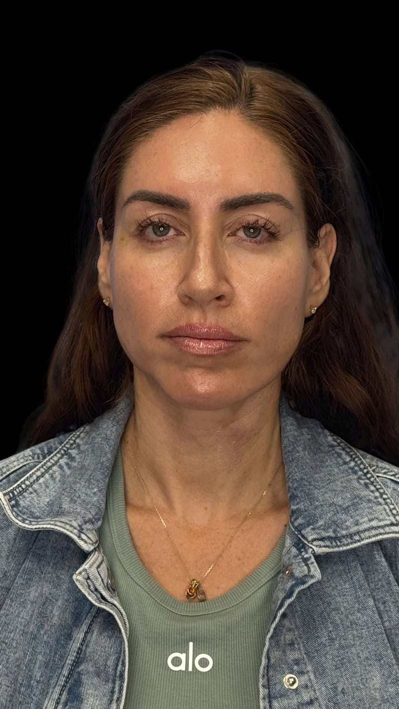 Deep Plane Facelift 40s Before & After Gallery - Patient 341532 - Image 2