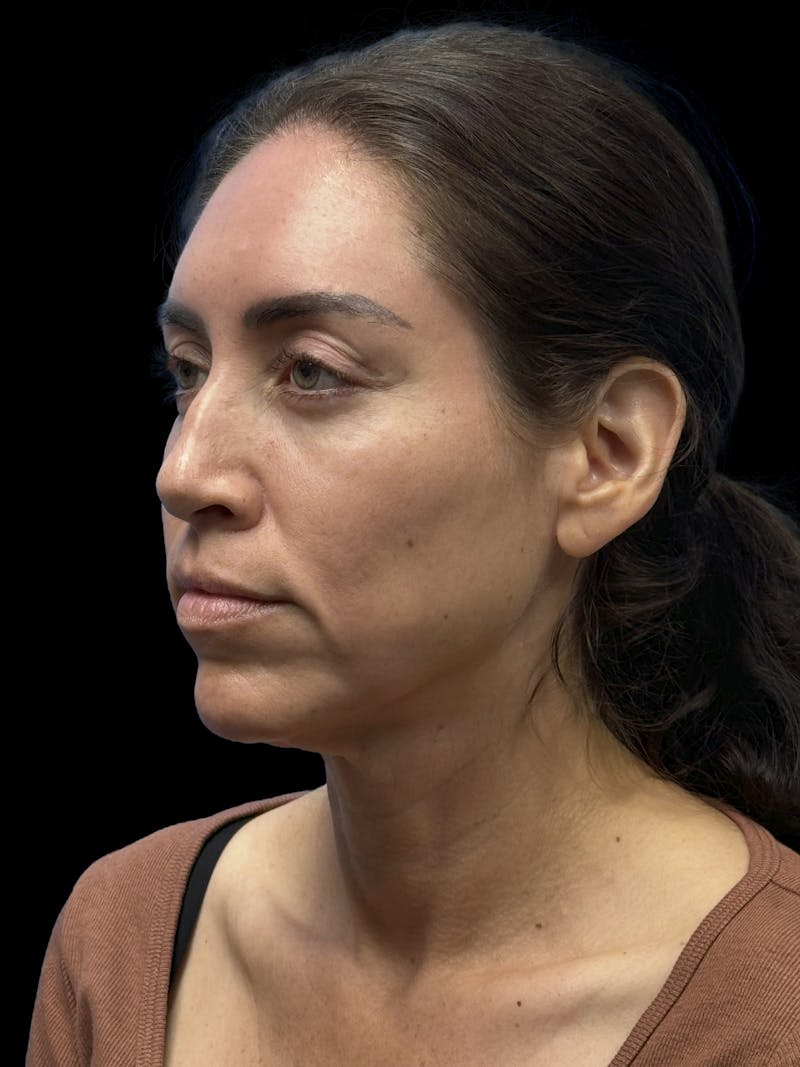 Deep Plane Facelift 40s Before & After Gallery - Patient 341532 - Image 3