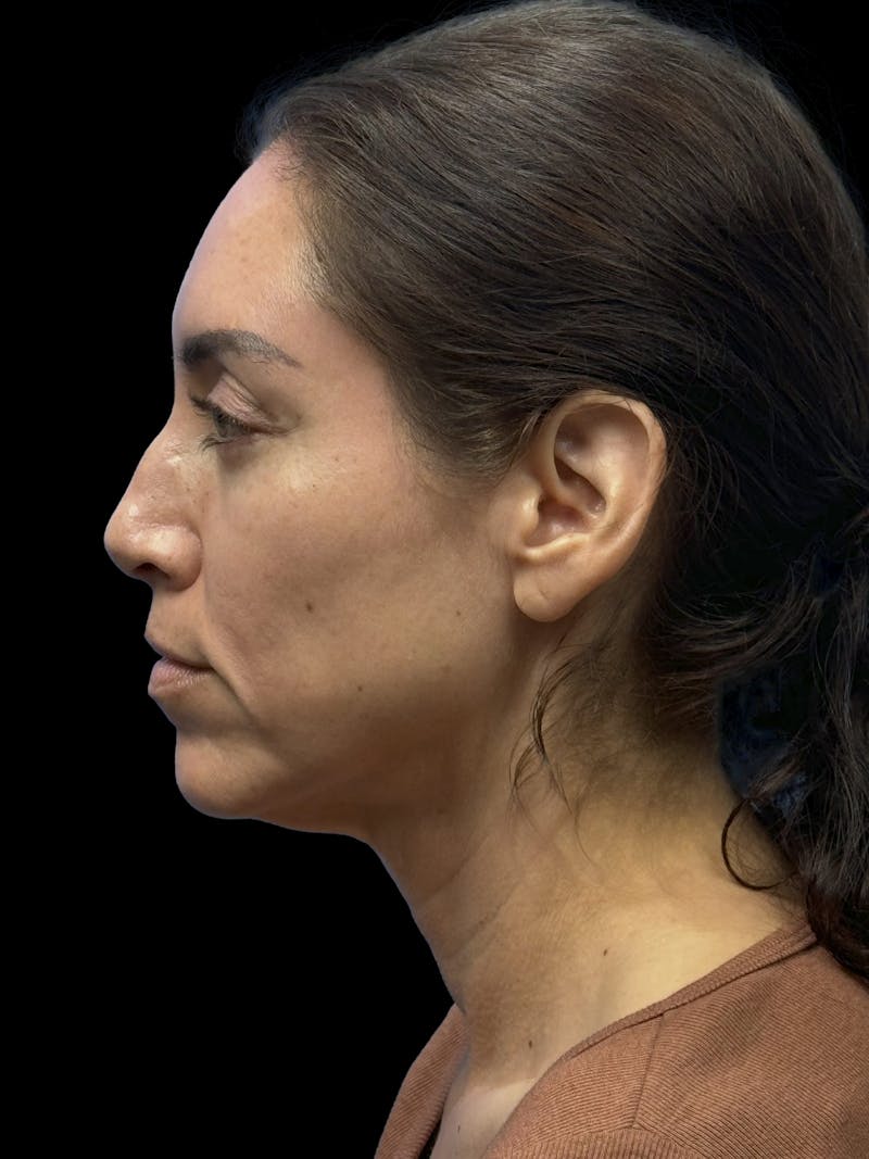 Deep Plane Facelift 40s Before & After Gallery - Patient 341532 - Image 5