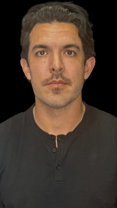 Cheek Implant Before & After Gallery - Patient 412696 - Image 2