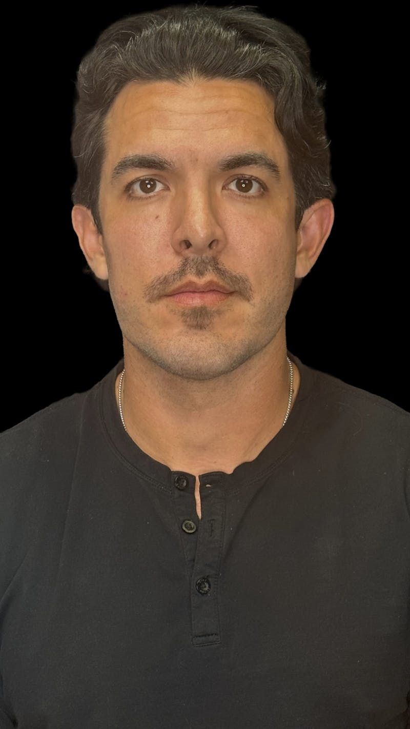 Cheek Implant Before & After Gallery - Patient 412696 - Image 2