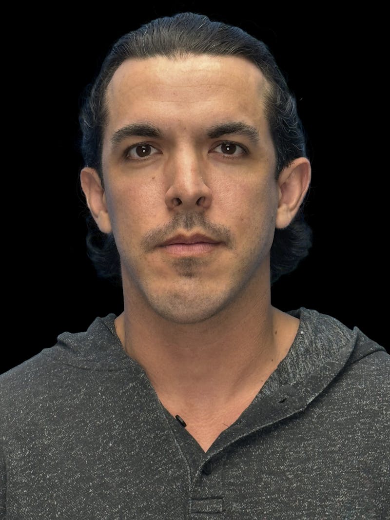 Cheek Implant Before & After Gallery - Patient 412696 - Image 1