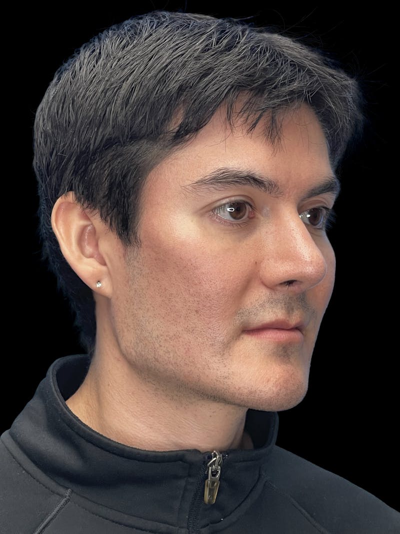 Custom Wrap Implants Before & After Gallery - Patient 416146 - Image 8