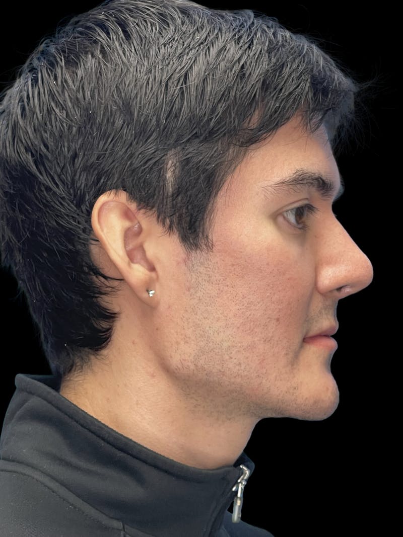Custom Wrap Implants Before & After Gallery - Patient 416146 - Image 10