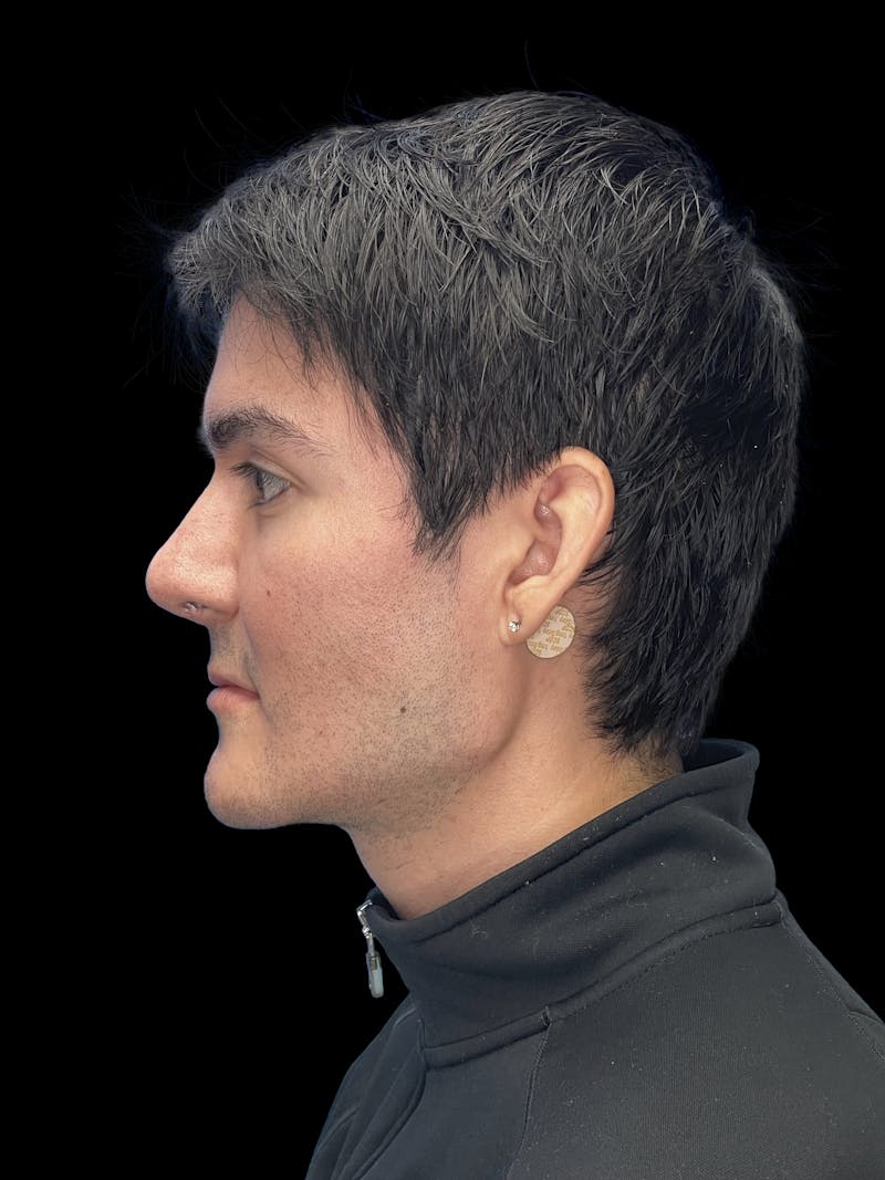 Custom Wrap Implants Before & After Gallery - Patient 416146 - Image 6