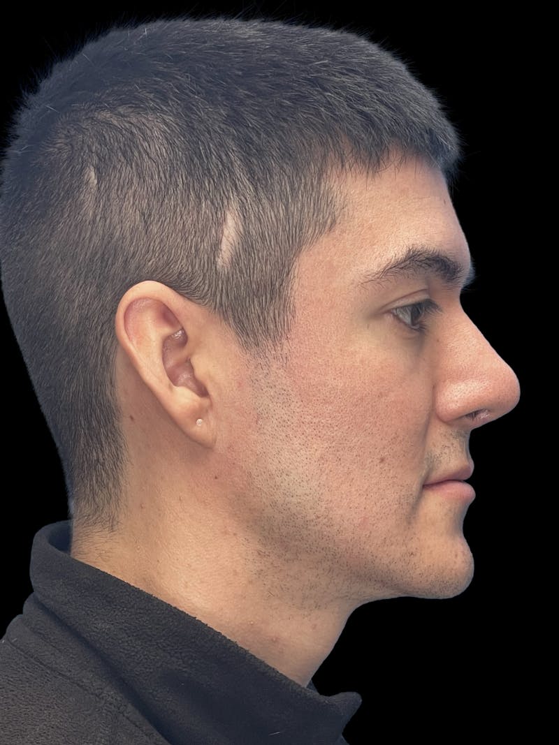 Custom Wrap Implants Before & After Gallery - Patient 416146 - Image 9