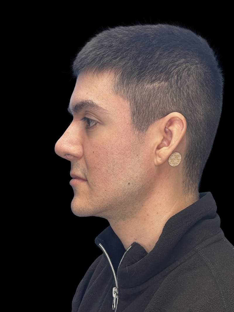 Custom Wrap Implants Before & After Gallery - Patient 416146 - Image 5