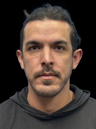 Chin Implant Before & After Gallery - Patient 300928 - Image 2